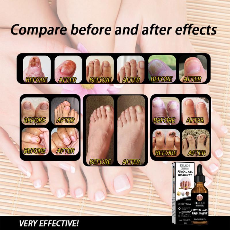 1PCS Toenail Fungus Treatment, Extra Strength Nail Fungus Remover, Toe Fingernail Repair Liquid Solution Fast Acting for Man and Woman Manicure Nailcare