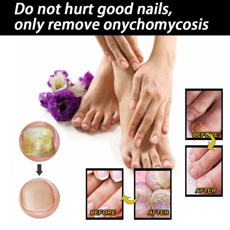 1PCS Toenail Fungus Treatment, Extra Strength Nail Fungus Remover, Toe Fingernail Repair Liquid Solution Fast Acting for Man and Woman Manicure Nailcare